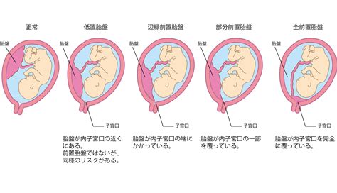 胎盤形成時期|胎盤の役割とは？いつ完成する？前置胎盤や早期剥離。